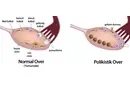 Polikistik Over Sendromu Belirtileri ve Tedavisi Polikistik Over Sendromu Belirtileri ve Tedavisi