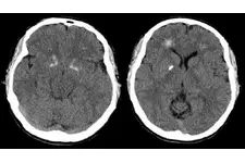 George Sendromu Nedir? George Sendromu Nedir?