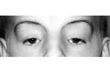 Joubert Sendromu Özellikleri Nelerdir?