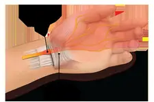 Karpal Tünel Sendromu Ameliyatı Riskleri ve Sonrası Karpal Tünel Sendromu Ameliyatı Riskleri ve Sonrası