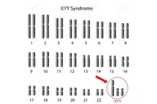 Xyy Sendromu Belirtileri ve Tedavisi
