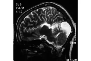 Dandy Walker Sendromu Belirtileri ve Tedavisi