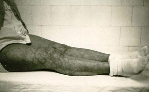 Antifosfolipid Antikor Sendromu Belirtileri ve Tedavisi