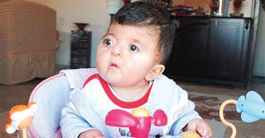 Apert Sendromu Belirtileri ve Tedavisi