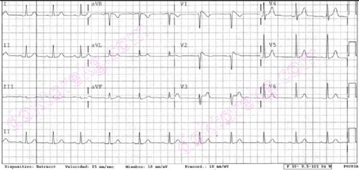 Brugada Sendromu Ekg