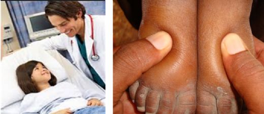 Çocuklarda Nefrotik Sendrom Belirtileri ve Tedavisi