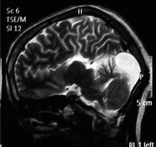 Dandy Walker Sendromu Belirtileri ve Tedavisi