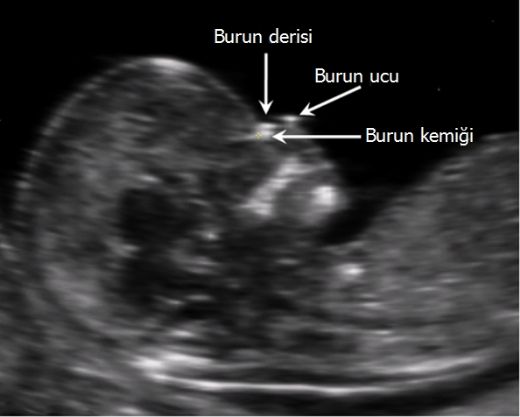 Down Sendromu Burun Kemiği