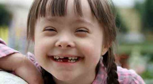 Down Sendromu Fiziksel Belirtileri Nelerdir?