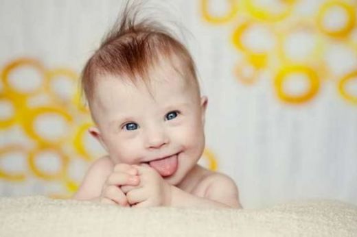 Down Sendromu Yaşam Süresi