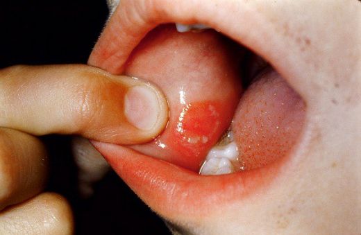 El Ayak Ağız Sendromu Belirtileri ve Tedavisi