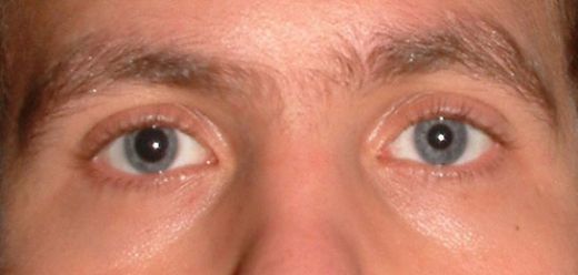 Horner Sendromu Belirtileri ve Tedavisi