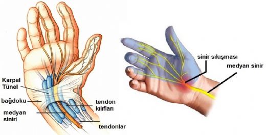 Karpal Tünel Sendromu Belirtileri ve Tedavisi
