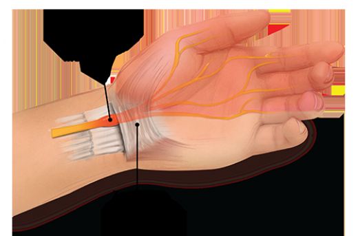 Karpal Tünel Sendromu Ameliyatı Riskleri ve Sonrası
