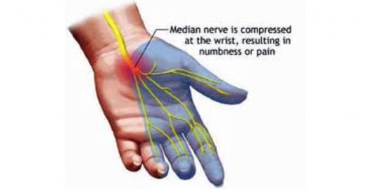 Kubital Tünel Sendromu Belirtileri ve Tedavisi