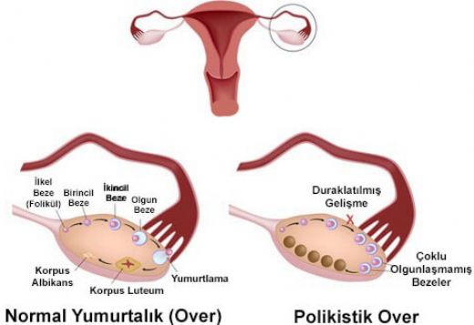 Polikistik Over Sendromu Hamilelik
