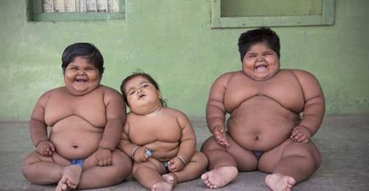 Prader Willi Sendromu Belirtileri ve Tedavisi