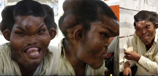 Proteus Sendromu Belirtileri ve Tedavisi