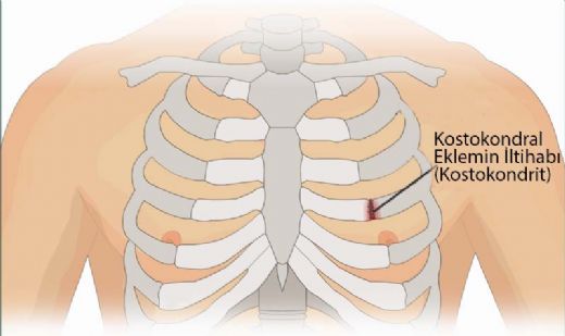 Tietze Sendromu Belirtileri ve Tedavisi
