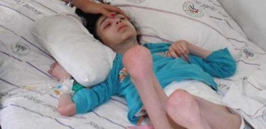 West Sendromu Belirtileri ve Tedavisi